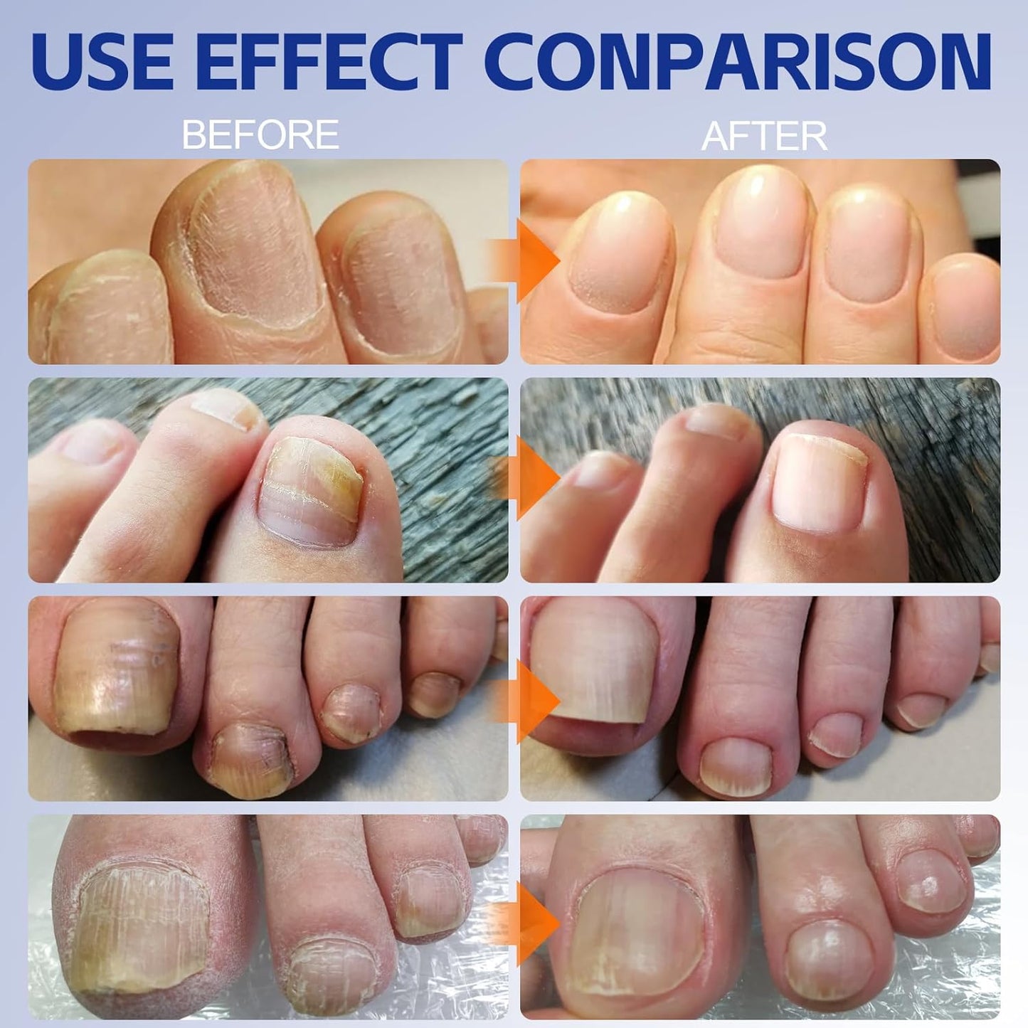 Apooliy 30ML Toenail Fungus Treatment Extra Strength, Powerful Nail Care Renewal & Recovery Liquid for Thick, Damaged & Discolored Nails Remedy