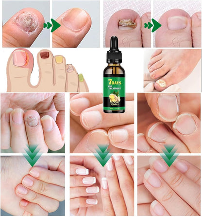 Ginger Nail Treatment Nail Support Nail Care, 7Days Nail Treatment Serum, Multipurpose Nail Repair, Ginger Nail Growth Serum, Nourishing Strengthening Nail Oil (1 PC)
