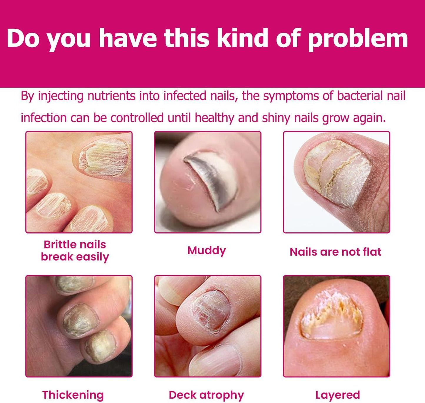 Fungigone Ginger Nail Essence, Fungigone Nail Treatment Toe, Natural Nails Fungus Treatment for Toenail & Foot Care, Regenerate Nails and Heal Wounds & Cracks (2 PCS)