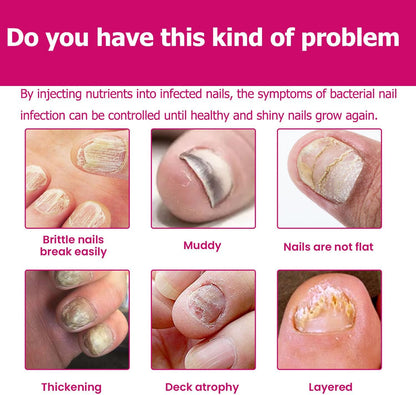 Fungigone Ginger Nail Essence, Fungigone Nail Treatment Toe, Natural Nails Fungus Treatment for Toenail & Foot Care, Regenerate Nails and Heal Wounds & Cracks (2 PCS)