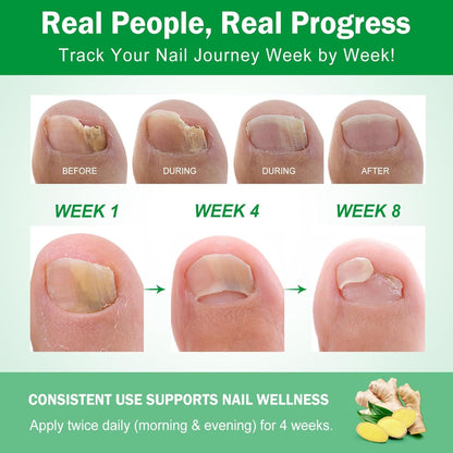 Ginger Nail Growth Serum,Ginger Nail Treatment Nail Support Nail Care,Nail Nutrient Oil Strengthener Oil,Nourishing Idratante