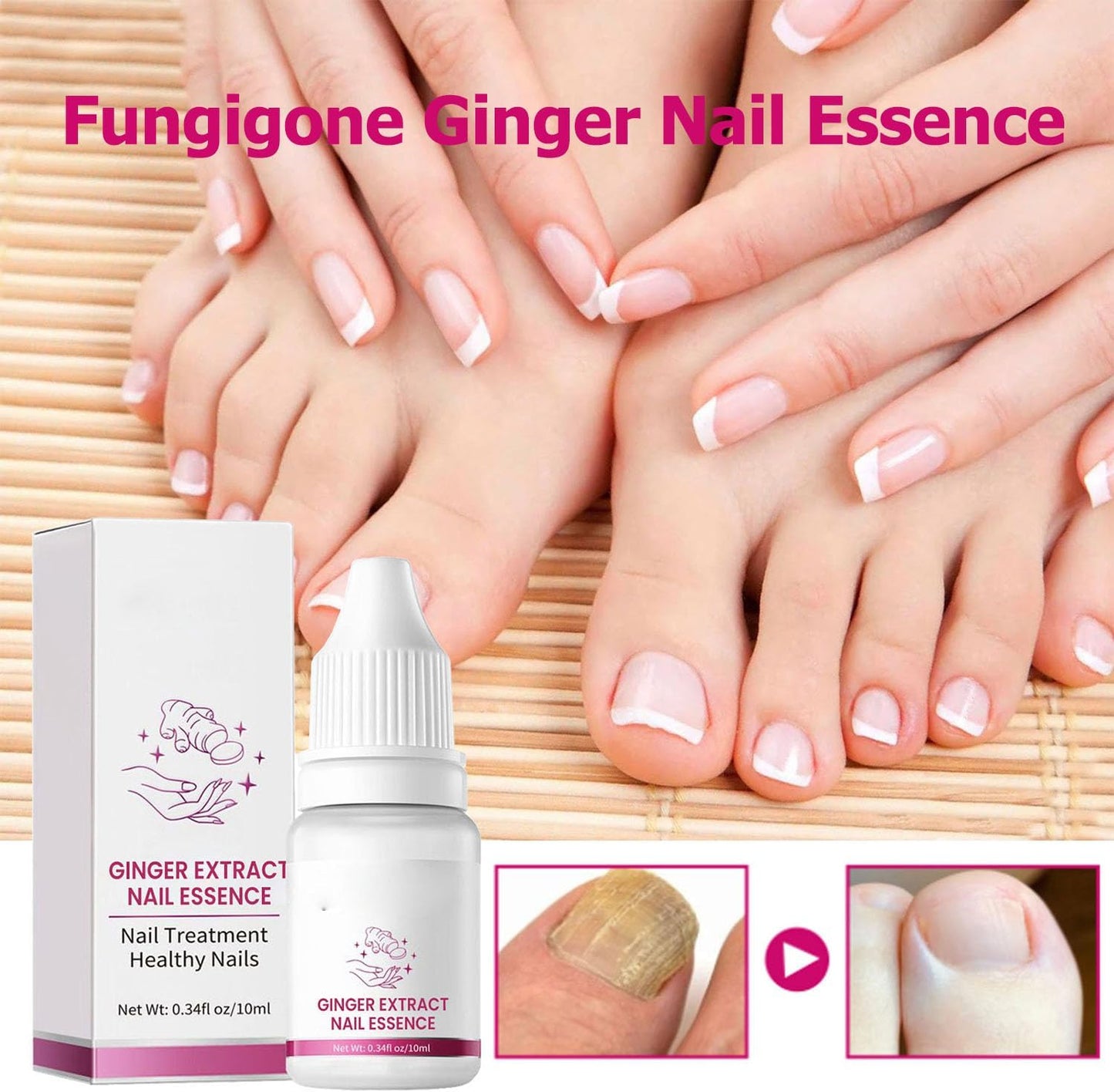 Fungigone Ginger Nail Essence, Fungigone Nail Treatment Toe, Natural Nails Fungus Treatment for Toenail & Foot Care, Regenerate Nails and Heal Wounds & Cracks (2 PCS)