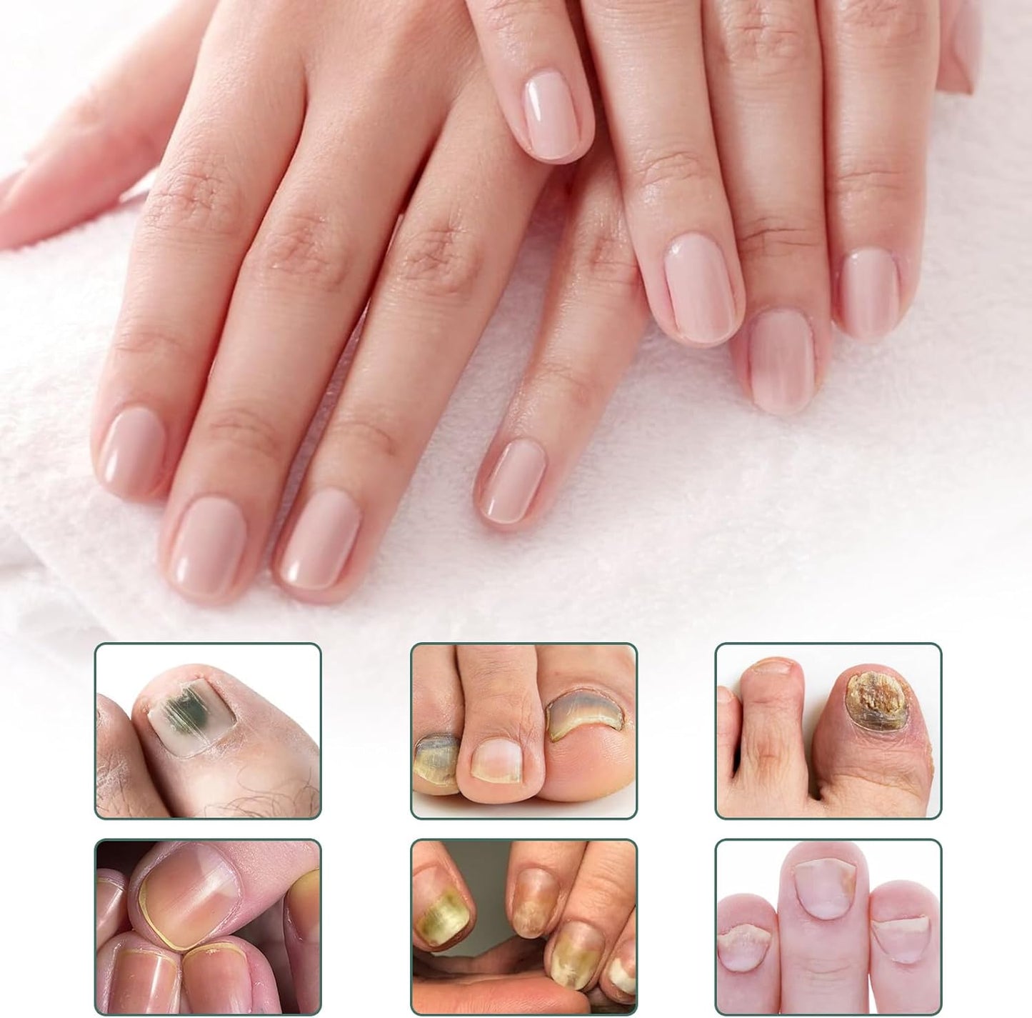 Apooliy Toenail Fungus Treatment，Nail Remedy Care for Damaged Nails and Appearance of Discolored，Nail Strengthener