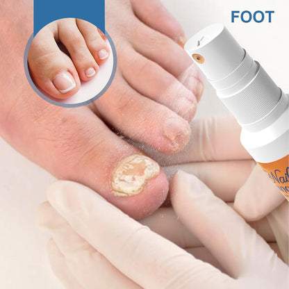 Nail Strengthener Spray, Toenail Care Treatments, 4.02x1.14in Gentle Long-Lasting Formula, Repair and Protect, Fast Absorbing Spray for Damaged Thickened Toenails Cares