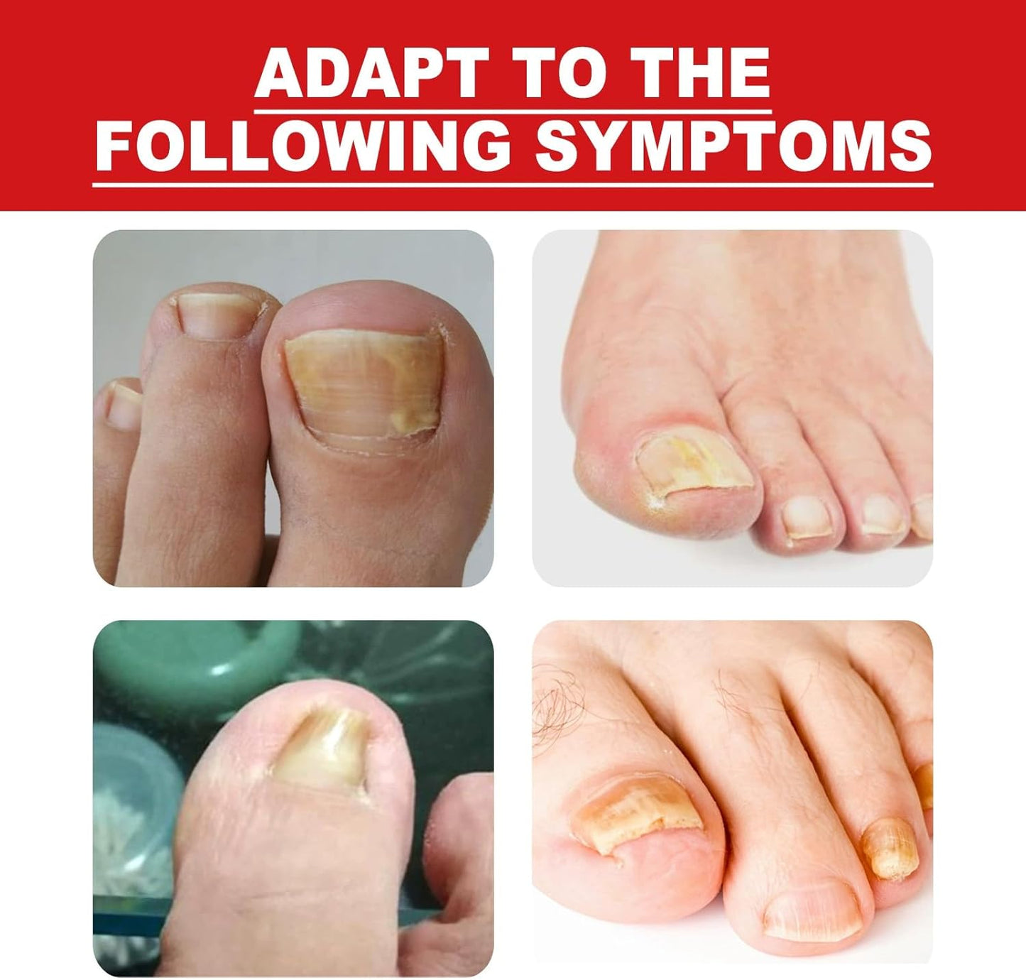 Ingrown Toenail Treatment Drop - Ingrown Toenail Treatment- Cuticle Care Oils for Ingrown Toenails - Trimming Toenail Softening Drops Natural Ingrown Toenail Correction Fungal Nail - 10ml