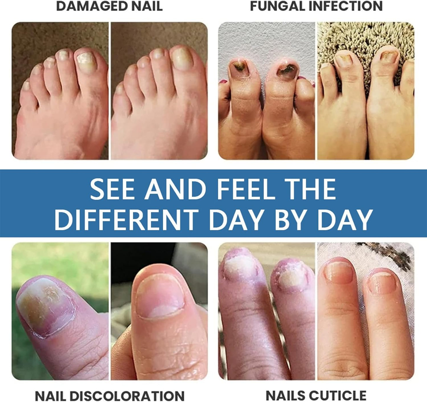 Nail Strengthener, Toenail Care Spray, 4.02x1.14x0.24 Inches Gentle Long Lasting, Portable Nails Repair Spray for Damaged and Thickened Toenails, Strengthens, Nourishes, Protects