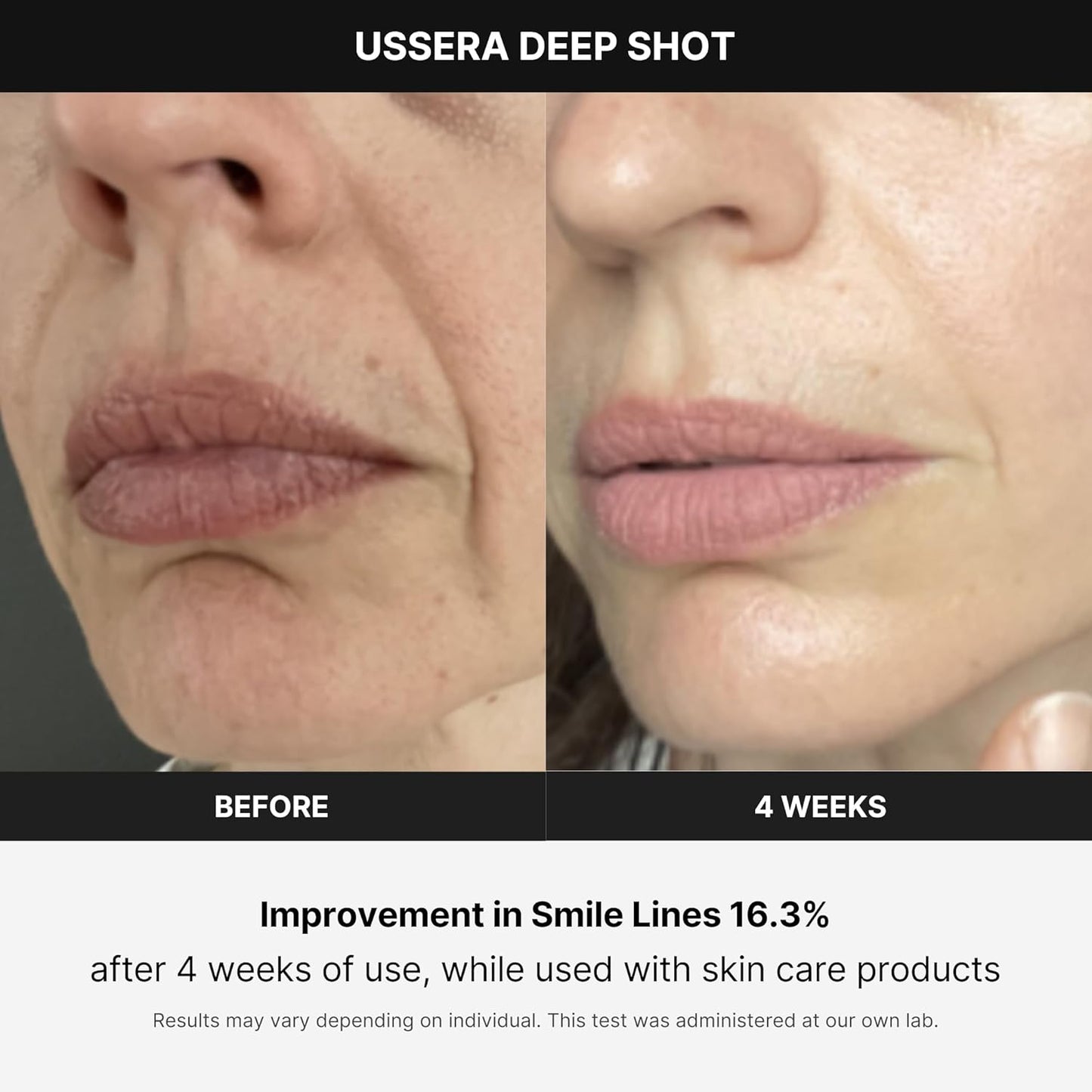Medicube Age-R USSERA Facial Treatment Device - at-Home Skin Care Device for Collagen Stimulation Wrinkle Reduction, and Youthful Complexion - Korean Skin Care