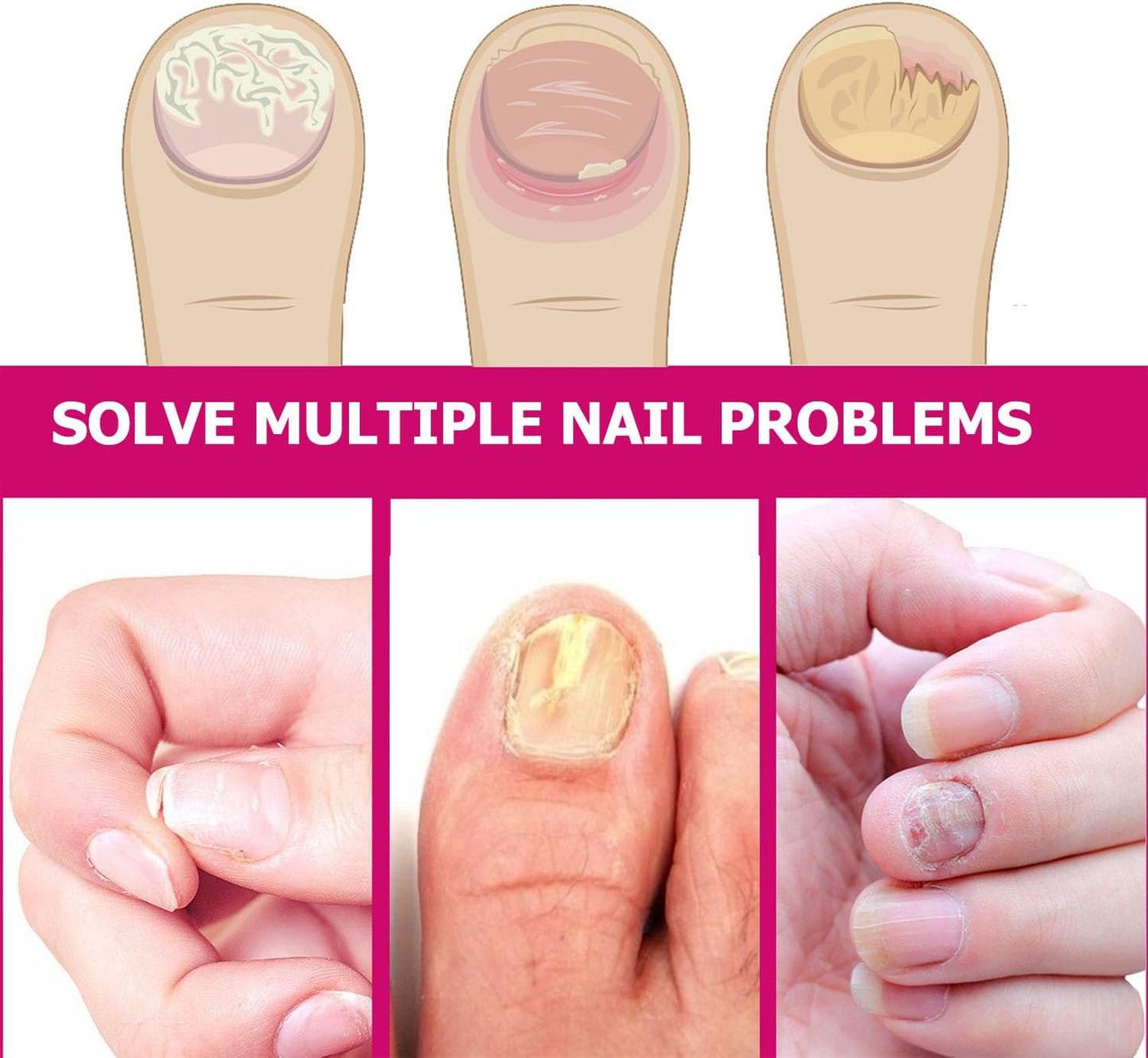 Fungigone Ginger Nail Essence, Fungigone Nail Treatment Toe, Natural Nails Fungus Treatment for Toenail & Foot Care, Regenerate Nails and Heal Wounds & Cracks (2 PCS)