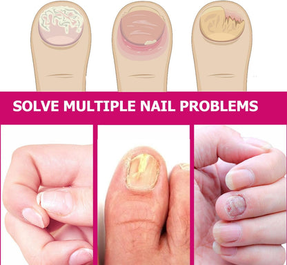 Fungigone Ginger Nail Essence, Fungigone Nail Treatment Toe, Natural Nails Fungus Treatment for Toenail & Foot Care, Regenerate Nails and Heal Wounds & Cracks (2 PCS)