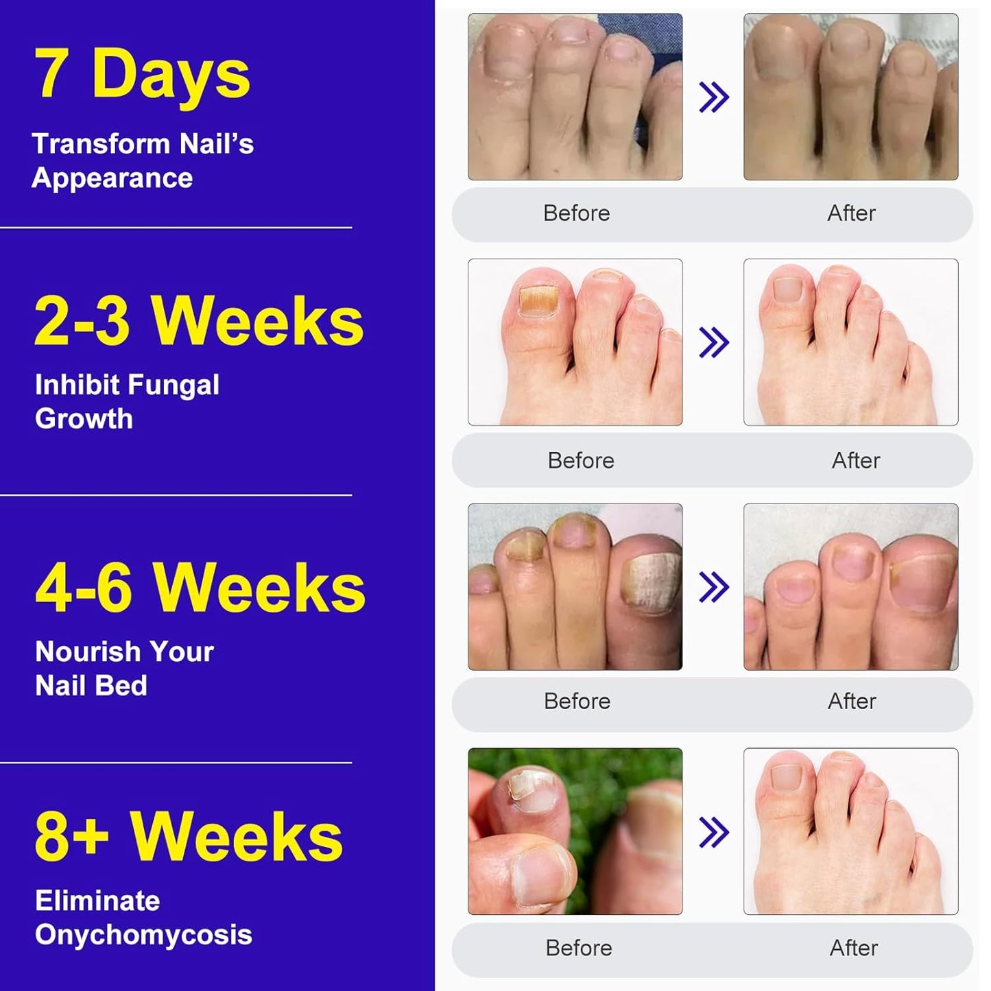 Toenail Treatment Extra Strength - 24 Pcs Nighttime Nail Patches, Overnight Toe Nail Treatments for Damaged Nails Foot Nails Repair and Care