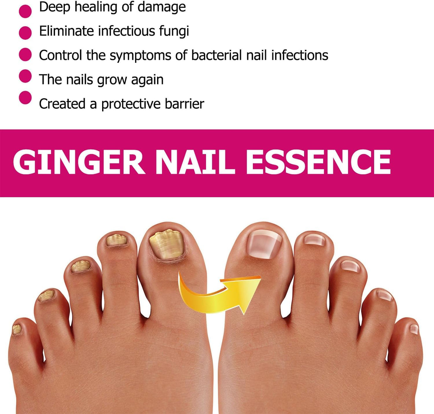 Fungigone Ginger Nail Essence, Fungigone Nail Treatment Toe, Natural Nails Fungus Treatment for Toenail & Foot Care, Regenerate Nails and Heal Wounds & Cracks (2 PCS)