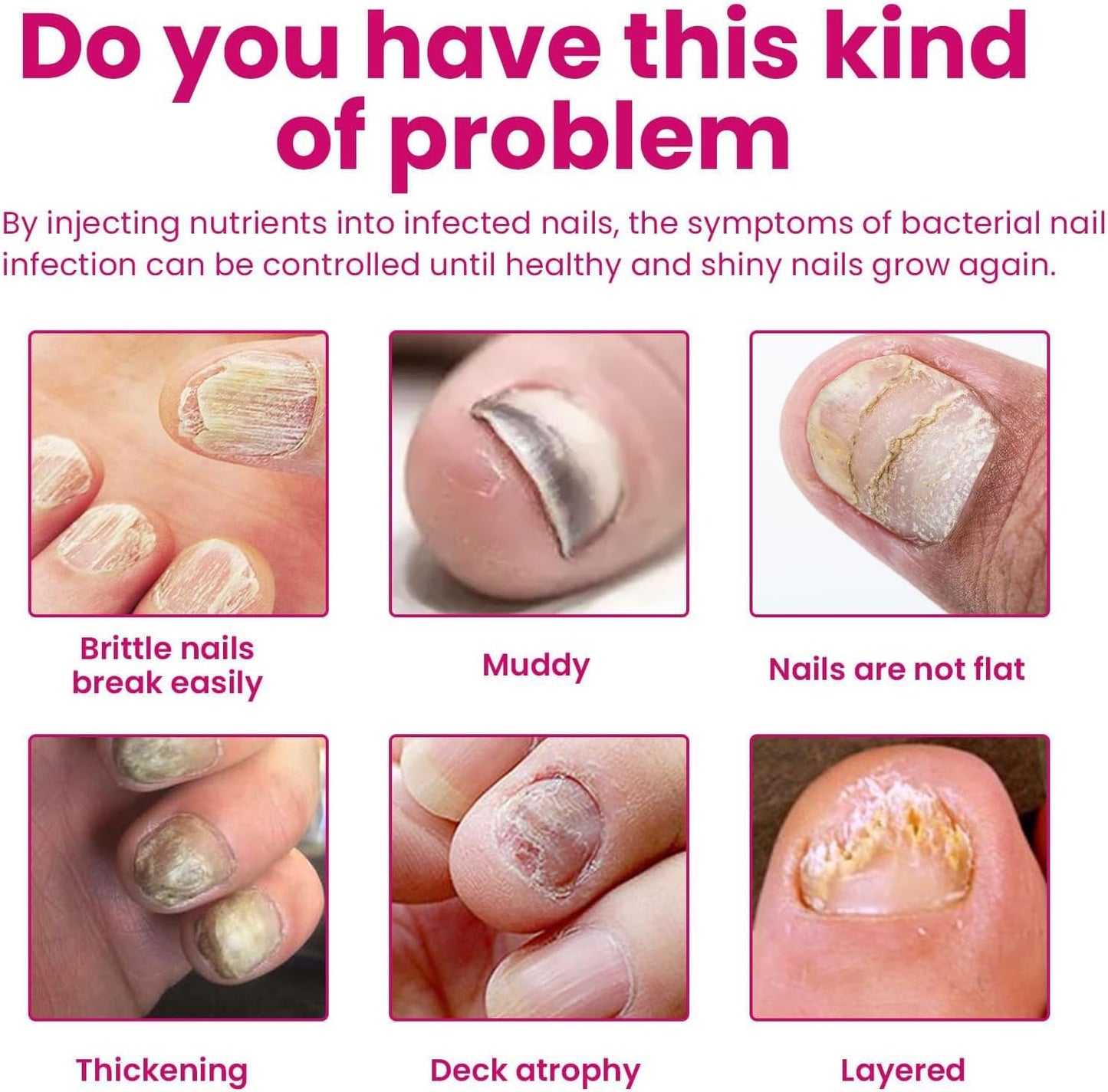 Fungigone Nail Treatment, Fungigone Nail Fungus Remover, For Toenail & Foot Care, Gentle, Fast-Absorbing Formula, Easy Daily Use (2)