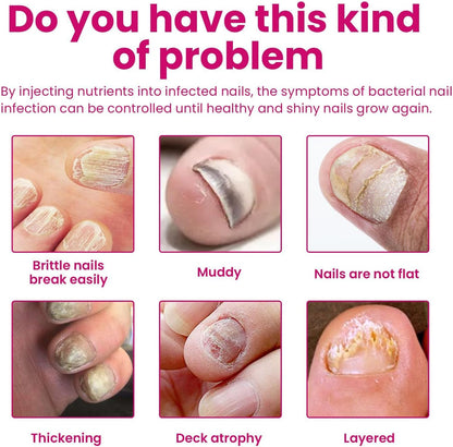 Fungigone Nail Treatment, Fungigone Nail Fungus Remover, For Toenail & Foot Care, Gentle, Fast-Absorbing Formula, Easy Daily Use (2)