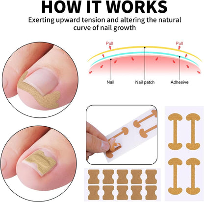 Oiieco 114 PCS Ingrown Toenail Treatment Kit with Corrector Strips,Nail Clippers & Tools,Professional Pain Relief for Ingrowing Toenails