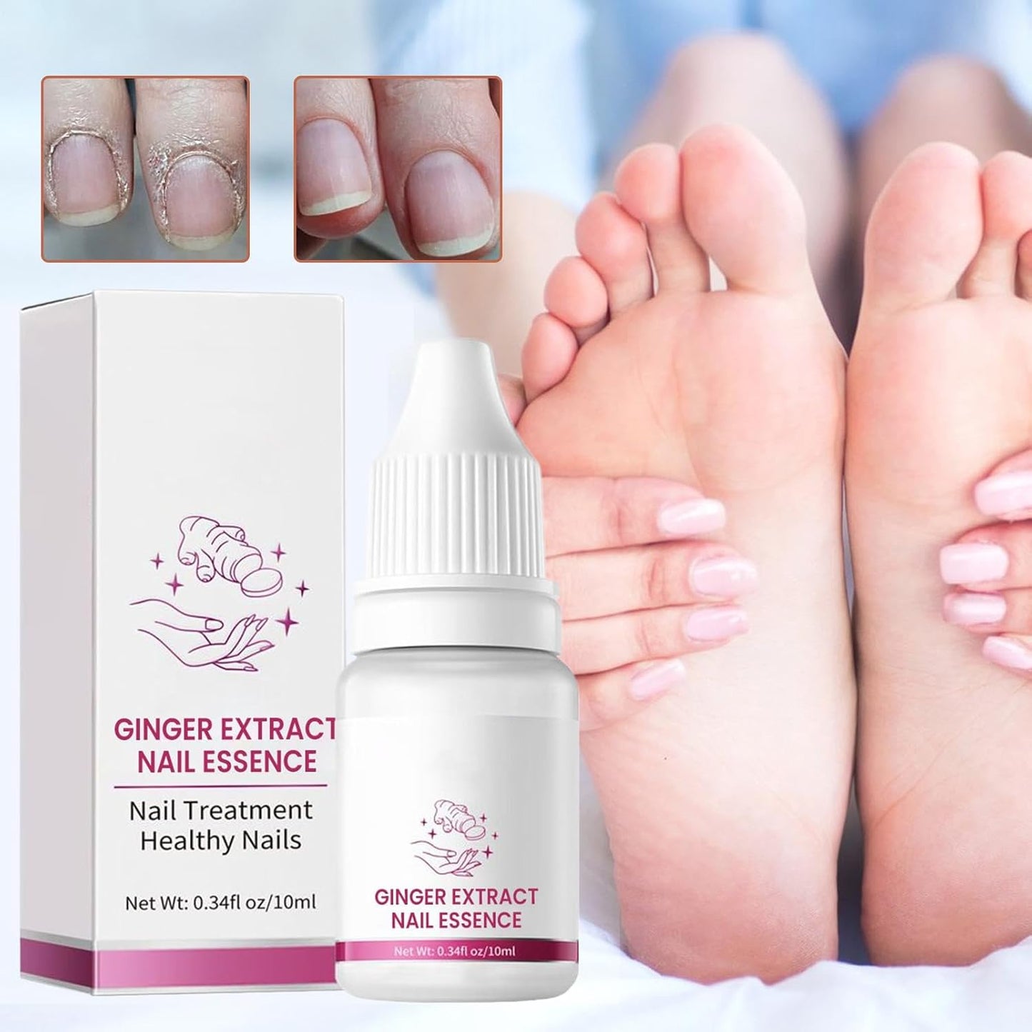 Nail Hardener, Natural Nail Growth Oil, Cuticle Repair and Softener, Strengthening for Foot Care, Fingernails, Yellow and Ingrown Nail Recovery, 10 ml