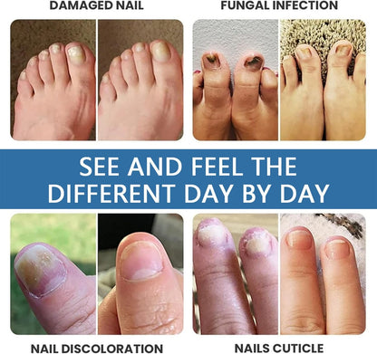 Nail Strengthener Spray, Toenail Care Treatments, 4.02x1.14in Gentle Long-Lasting Formula, Repair and Protect, Fast Absorbing Spray for Damaged Thickened Toenails Cares