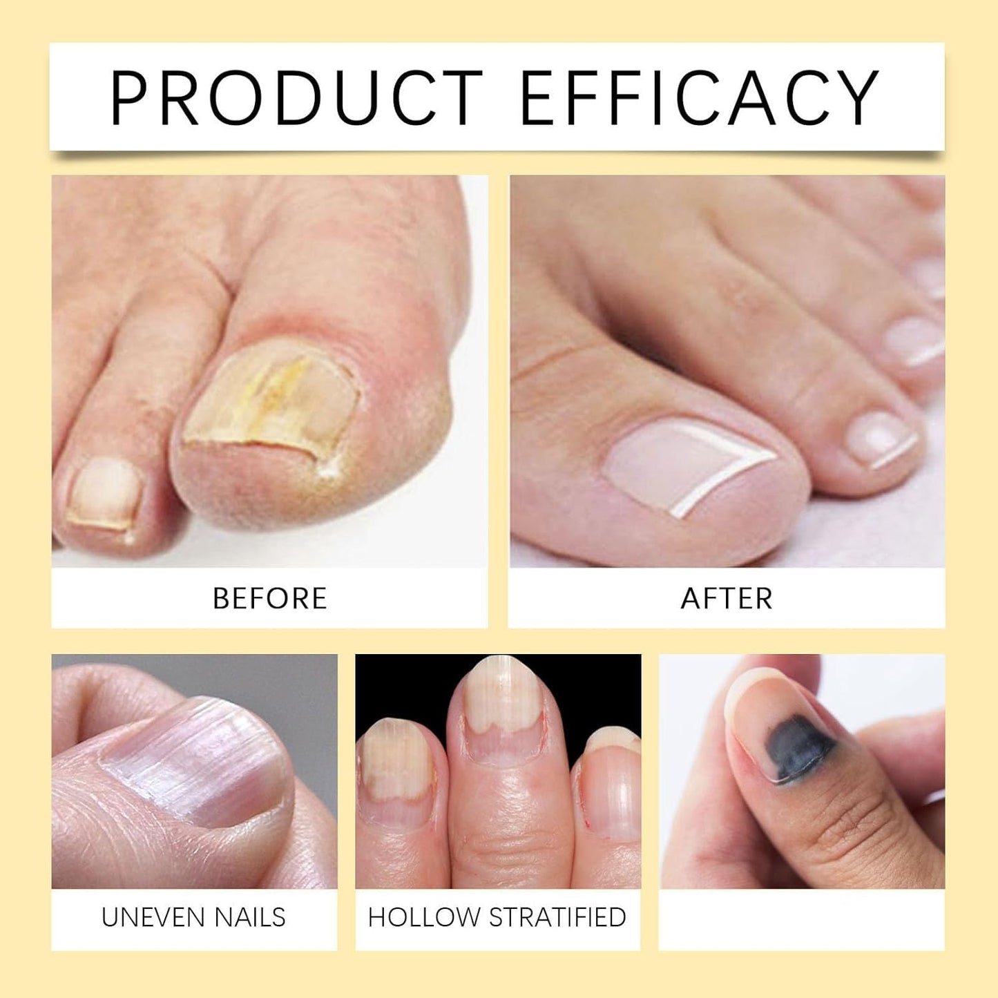Ape Venom Nail Lenothing Solution, Rafforzante Unghie per Unghie Dannate, Siero di Cura del Veno d'Ape, Fungal Nail Treatment Nail Care Essence (1)