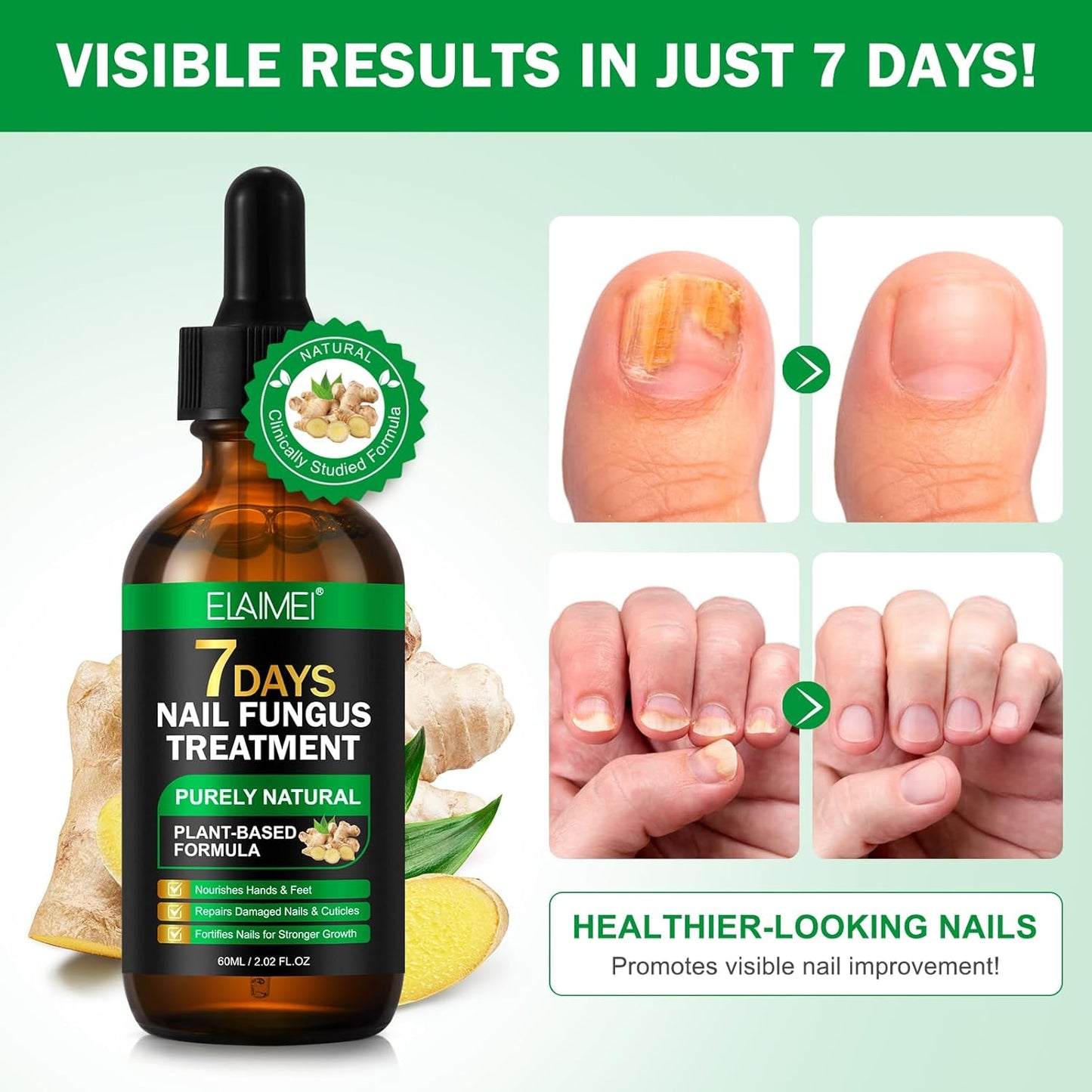 7 Day Nail Fungus Treatment | Natural Plant-Based Nail Repair Oil with Ginger Extract | Strengthens & Nourishes Nails & Cuticles | Repairs Discolouration & Brittleness | Suitable for Hands & Feet | 60mL