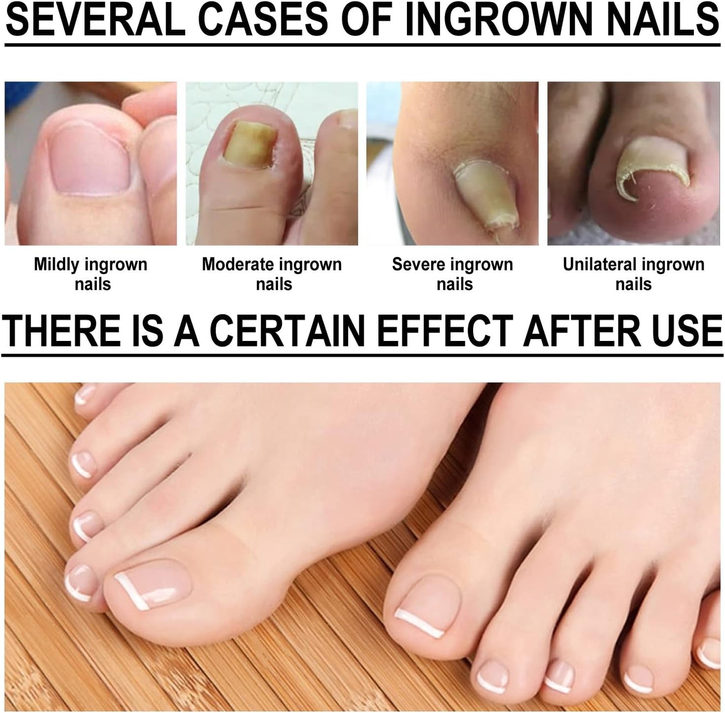 Nailhelper Ingrowth Toenail Correction Oil, Ingrown Toenail Drops, Nail & Cuticle Care, Ingrown Toenail Tool for Nail Repair (2pcs)