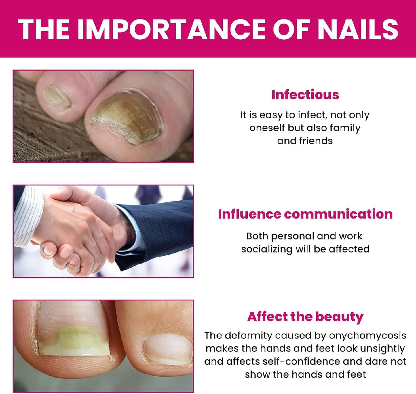 Fungigone Nail Treatment, Fungal Nail Care Strong Removal, Nail Repair Growth Treatment, Nail Softener for Thick Toenails Toe and Finger Nail Solution (1PCS)