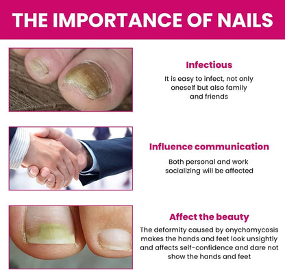 Fungigone Nail Treatment, Fungal Nail Care Strong Removal, Nail Repair Growth Treatment, Nail Softener for Thick Toenails Toe and Finger Nail Solution (1PCS)