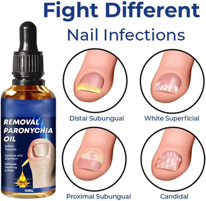 German Toenailcare Removal Paronychia Oil, Care Oil for Removing Paronychia, Toenail Treatment Best Nail Repair Solution,Nail Renewal Liquid for Damaged & Discoloration Nail (2 Pieces)