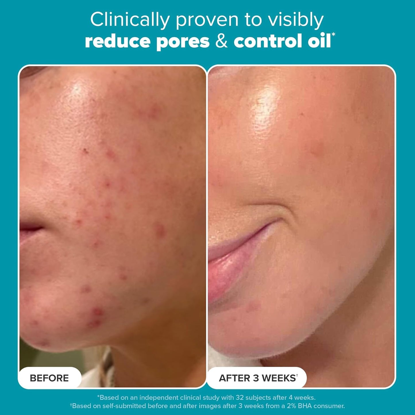 Paula's Choice Skin Perfecting 2% BHA Liquid Salicylic Acid Exfoliant, Gentle Facial Exfoliator for Blackheads, Large Pores, Wrinkles & Fine Lines, Travel Size, 30 mL Bottle
