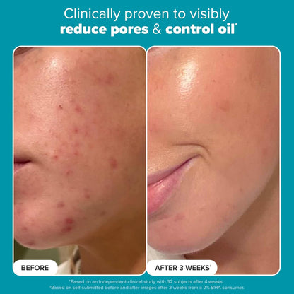 Paula's Choice Skin Perfecting 2% BHA Liquid Salicylic Acid Exfoliant, Gentle Facial Exfoliator for Blackheads, Large Pores, Wrinkles & Fine Lines, Travel Size, 30 mL Bottle