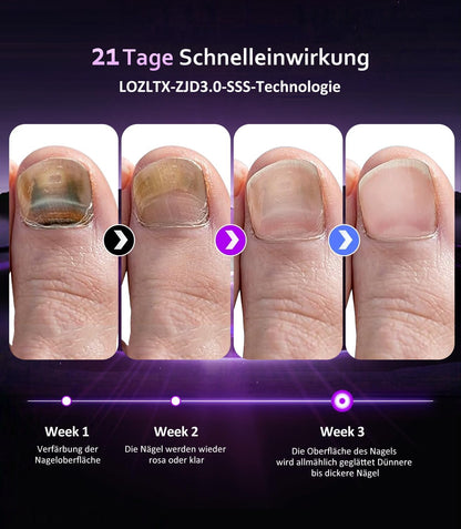 LOZLTX 4.0 Quality Nail Mushroom Laser & Stopwatch & Fruity Nail Care Pen【Stronger Fast Acting Therapy】Nail Mushroom Laser Device 【SGS Approved Safe and Reliable】Improved