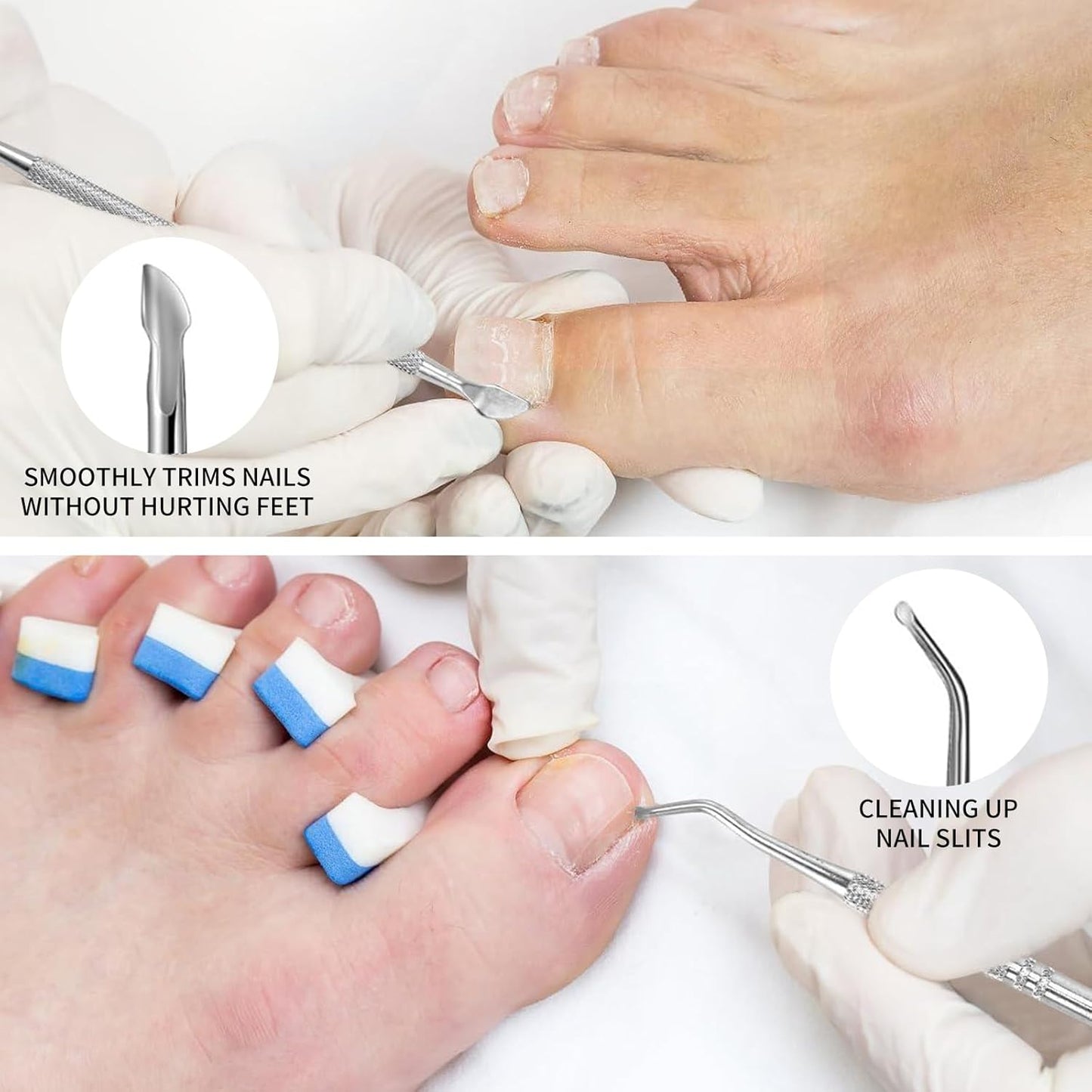 Oiieco 114 PCS Ingrown Toenail Treatment Kit with Corrector Strips,Nail Clippers & Tools,Professional Pain Relief for Ingrowing Toenails