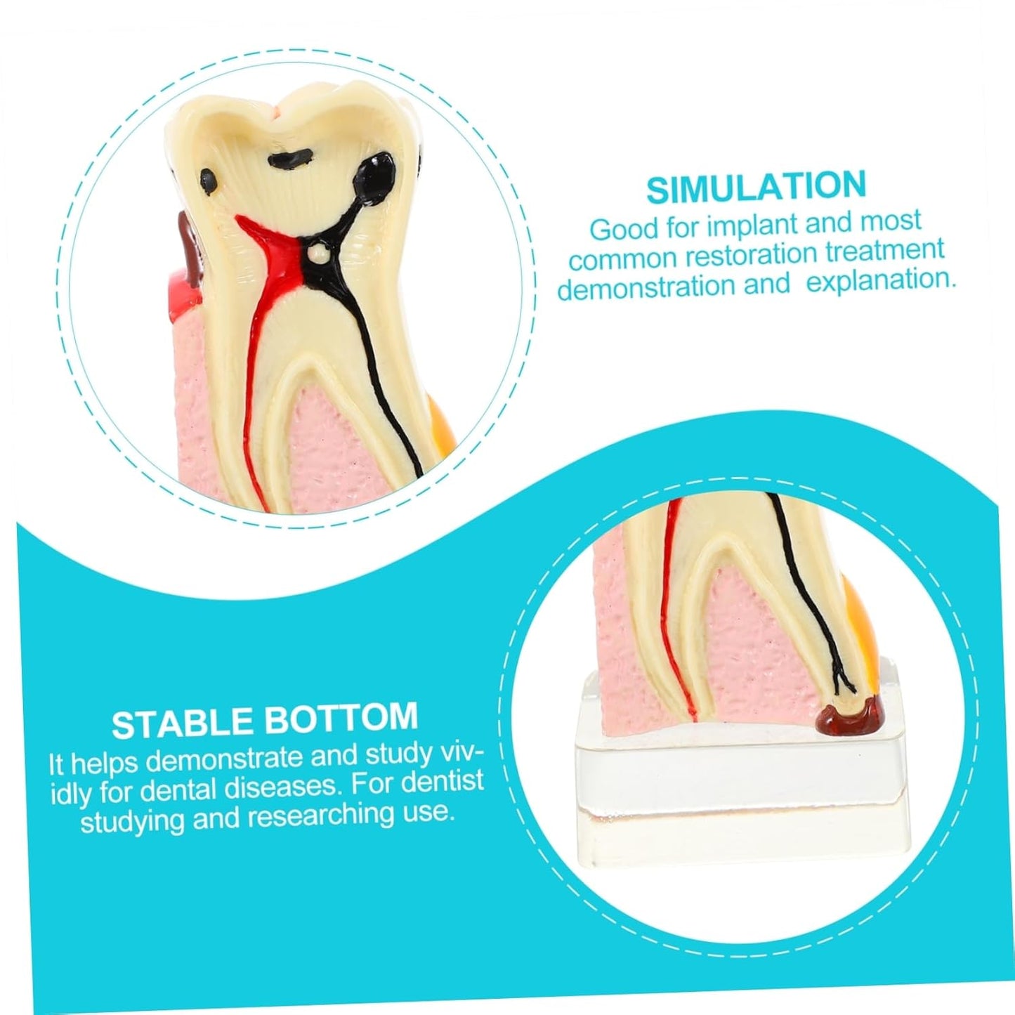 KICHOUSE 4 Caries Model Tooth Model Demonstration Model Teeth Model Teaching Oral Model Toy Teeth for Teeth Models for Education Model