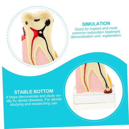 KICHOUSE 4 Caries Model Tooth Model Demonstration Model Teeth Model Teaching Oral Model Toy Teeth for Teeth Models for Education Model