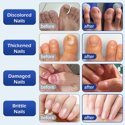 Multi-Purpose Nail Repair, Nail Solution with Tea Tree Oil for Discolored and Damaged Nails，Plant Drops for Nails Care，Discolored and Damaged Nails (1PC) ﻿