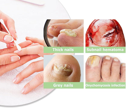 Nail Care Pen, Broken Nail Repair, Nail Care Pen, Nail Repair Pen