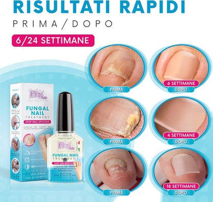 Antifungal Nail Feet and Hands 12 ml – Treatment Prevents Mycosis/Fungi and Restores the Natural Appearance of the Nail.