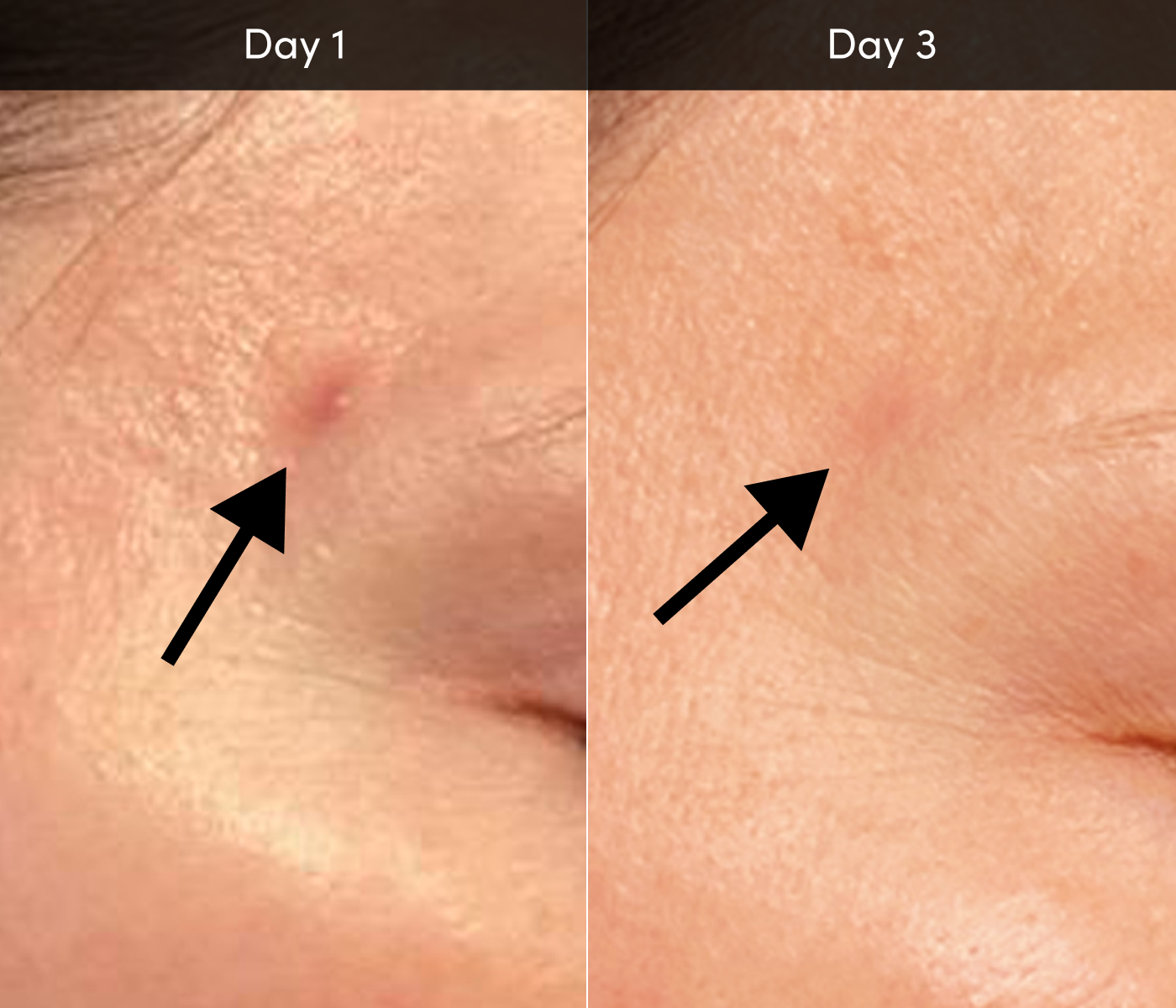 Acne Device