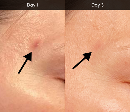 Acne Device