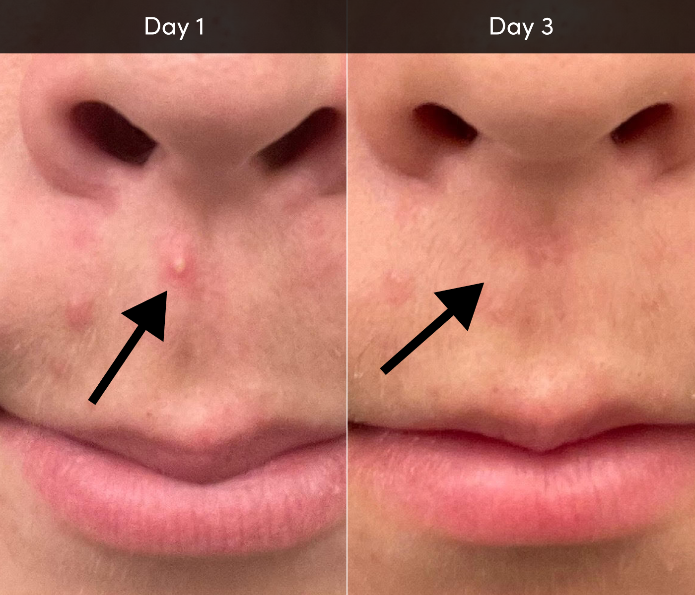 Acne Device