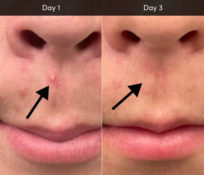 Acne Device